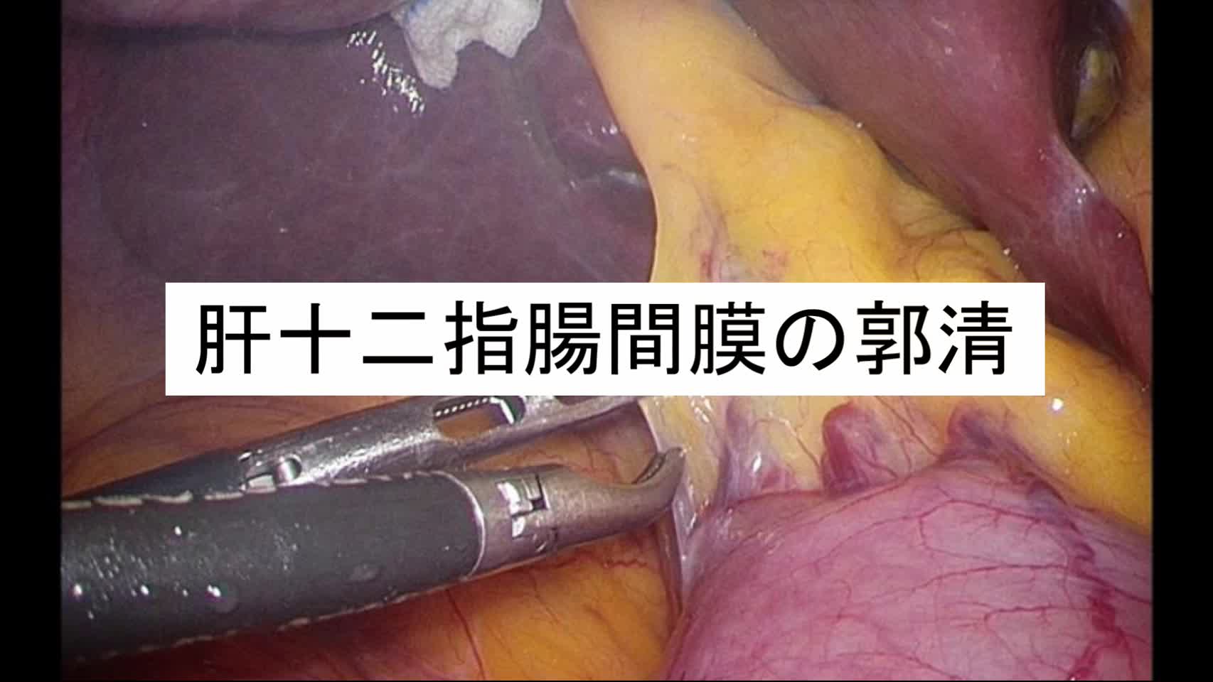 肝十二指腸間膜の郭清